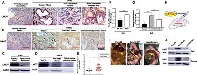 LMO7 as an Unrecognized Factor Promoting Pancreatic Cancer Progression and Metastasis